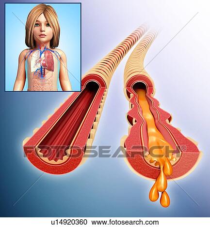 Stock Image - Child's infected bronchi, illustration. Fotosearch
