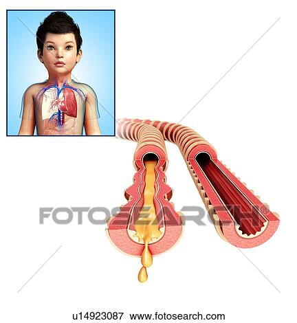 Stock Photo - Child's infected bronchi, illustration. Fotosearch