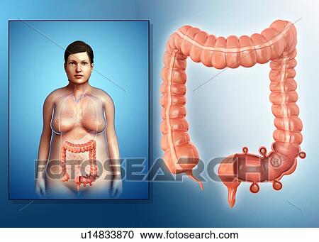 Diverticulosis, illustration View Large Photo Image Stock Image - Diverticulosis, illustration. Fotosearch