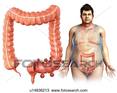 Diverticulosis, illustration View Large Photo Image Stock Image - Diverticulosis, illustration. Fotosearch