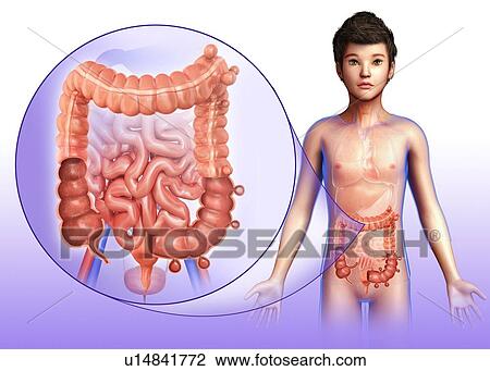 Stock Image - Diverticulosis, illustration. Fotosearch