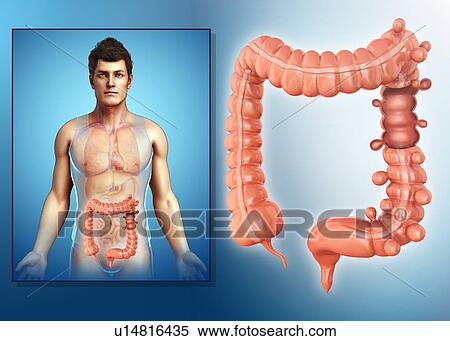 Diverticulosis, illustration View Large Photo Image Stock Photography - Diverticulosis, illustration. Fotosearch