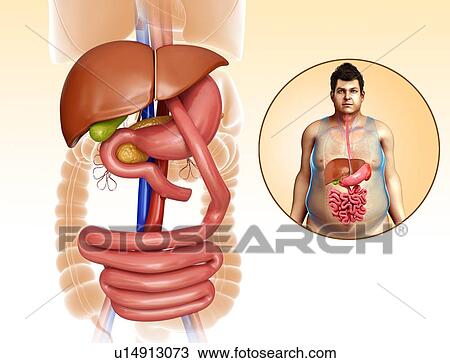 Stock Image - Gastric bypass, illustration. Fotosearch