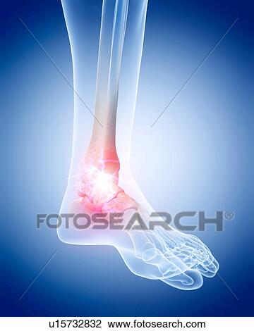 Stock Image - Human ankle pain. Fotosearch