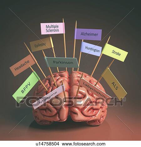 Picture - Human brain with medical conditions. Fotosearch