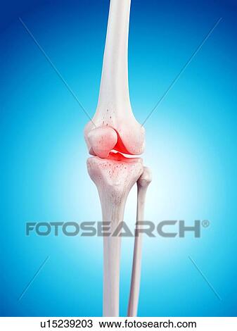 Stock Image - Human knee pain. Fotosearch