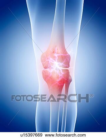 Stock Photo - Human knee pain. Fotosearch