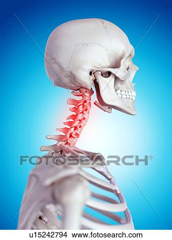 Picture - Human neck pain. Fotosearch