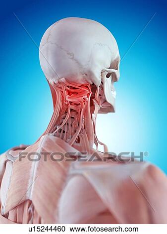Stock Image - Human neck pain. Fotosearch