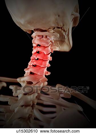 Stock Image - Human neck pain. Fotosearch