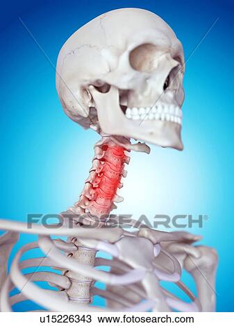 Stock Image - Human skull and neck pain. Fotosearch