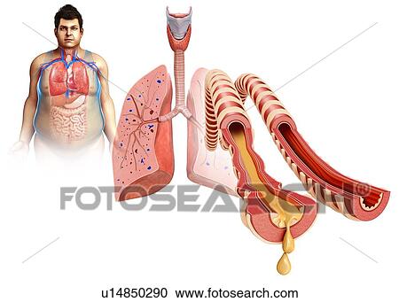 Stock Image - Infected human lungs, illustration. Fotosearch