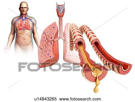 Stock Photography - Infected human lungs, illustration. Fotosearch