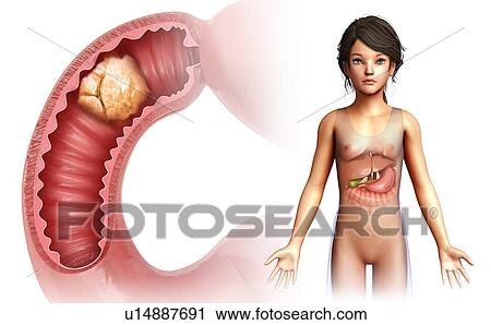 Stock Image - Intestinal tumour, illustration. Fotosearch
