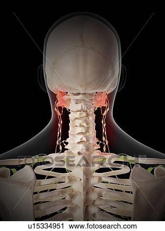 Stock Image - Painful human lymph nodes. Fotosearch