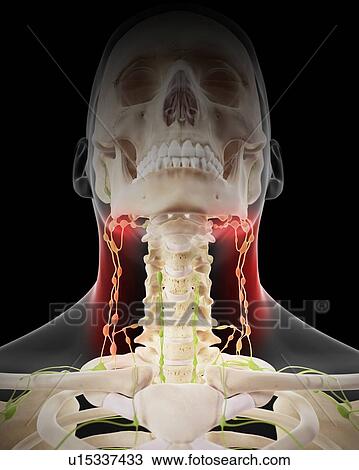 Stock Image - Painful human lymph nodes. Fotosearch
