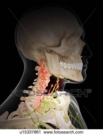 Stock Image - Painful human lymph nodes. Fotosearch