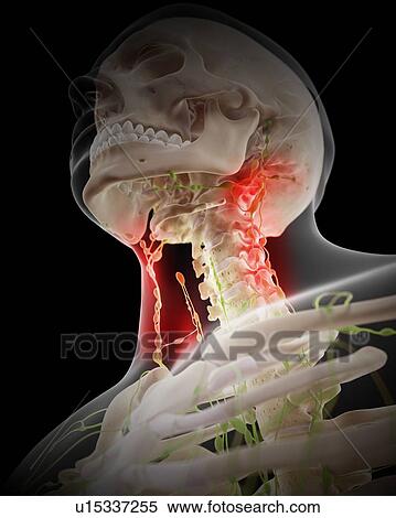 Painful human lymph nodes View Large Photo Image Stock Photography - Painful human lymph nodes. Fotosearch