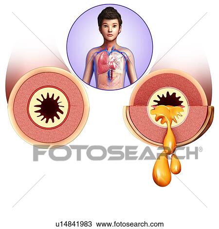 Stock Image - Teenager's infected bronchi. Fotosearch