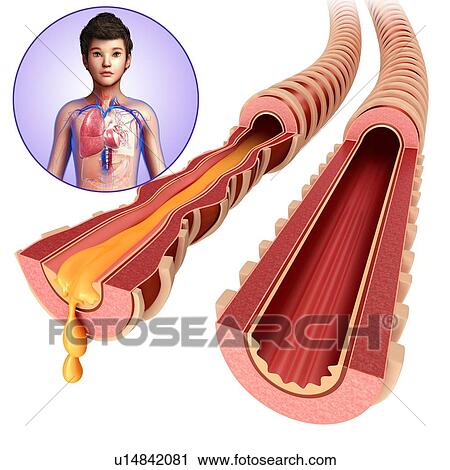 Teenager's infected bronchi View Large Photo Image Stock Image - Teenager's infected bronchi. Fotosearch