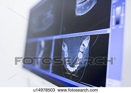 Teeth x-ray View Large Photo Image Stock Image - Teeth x-ray. Fotosearch