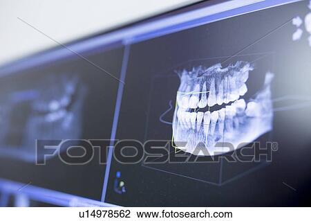 Teeth x-ray View Large Photo Image Stock Image - Teeth x-ray. Fotosearch