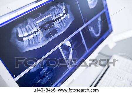 Teeth x-ray View Large Photo Image Stock Photograph - Teeth x-ray. Fotosearch