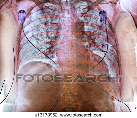 Stock Image - Aspiration, chest X-ray. Fotosearch