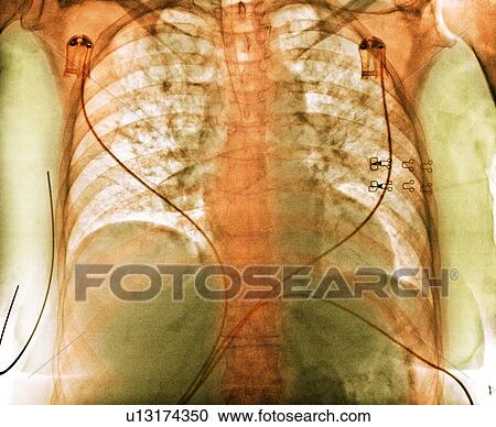 Stock Image - Aspiration, chest X-ray. Fotosearch