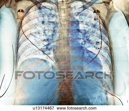 Stock Photo - Aspiration, chest X-ray. Fotosearch