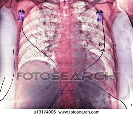 Aspiration, chest X-ray View Large Photo Image Stock Photograph - Aspiration, chest X-ray. Fotosearch