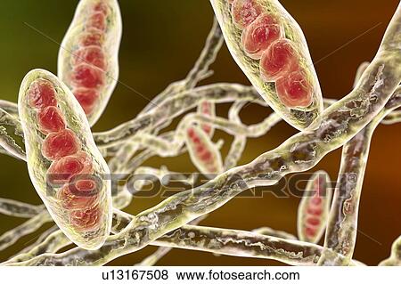 Athlete's foot fungus, illustration View Large Photo Image Stock Photo - Athlete's foot fungus, illustration. Fotosearch