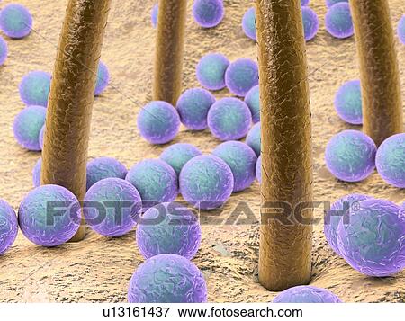 Bacteria on skin with hairs, illustration View Large Photo Image Stock Photo - Bacteria on skin with hairs, illustration. Fotosearch