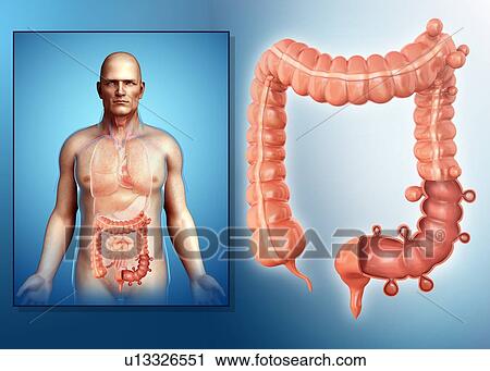 Stock Image - Diverticulosis, illustration. Fotosearch