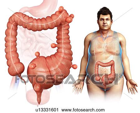 Diverticulosis, illustration View Large Photo Image Stock Image - Diverticulosis, illustration. Fotosearch