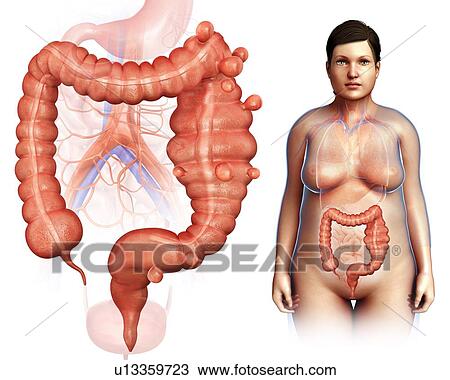 Stock Image - Diverticulosis, illustration. Fotosearch