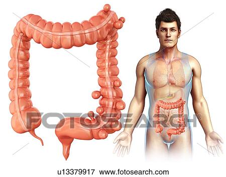 Diverticulosis, illustration View Large Photo Image Stock Photo - Diverticulosis, illustration. Fotosearch