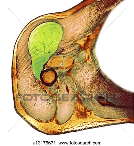 Stock Image - Lipoma of the shoulder, X-ray. Fotosearch