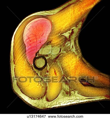 Stock Photo - Lipoma of the shoulder, X-ray. Fotosearch