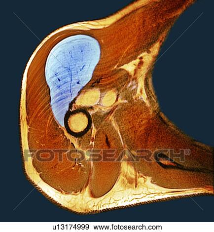 Lipoma of the shoulder, X-ray View Large Photo Image Stock Photo - Lipoma of the shoulder, X-ray. Fotosearch