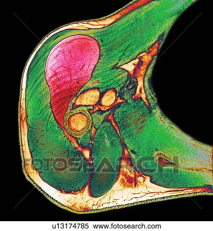 Lipoma of the shoulder, X-ray View Large Photo Image Stock Photography - Lipoma of the shoulder, X-ray. Fotosearch