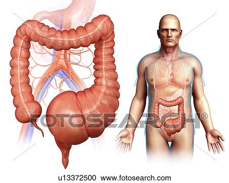 Stock Image - Megacolon, illustration. Fotosearch