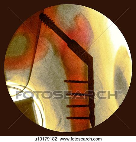 Stock Image - Pinned fractured hip, X-ray. Fotosearch