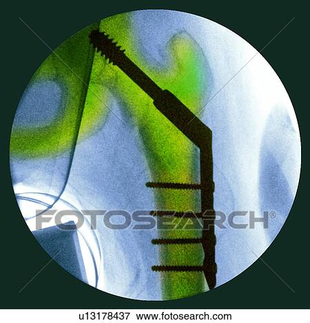 Pinned fractured hip, X-ray View Large Photo Image Stock Photo - Pinned fractured hip, X-ray. Fotosearch
