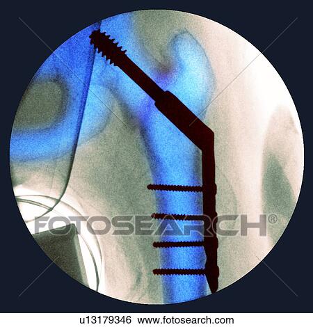 Pinned fractured hip, X-ray View Large Photo Image Stock Photograph - Pinned fractured hip, X-ray. Fotosearch