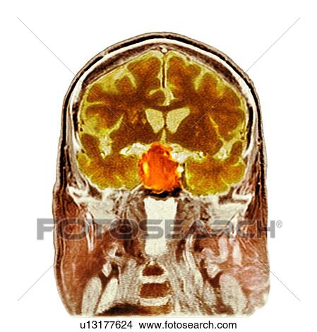 Pituitary tumour, CT scan View Large Photo Image Picture - Pituitary tumour, CT scan. Fotosearch