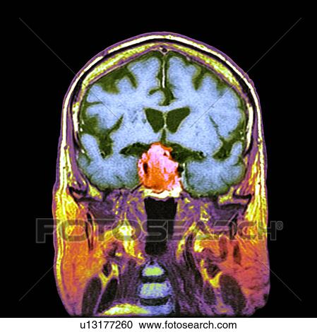 Pituitary tumour, CT scan View Large Photo Image Stock Image - Pituitary tumour, CT scan. Fotosearch