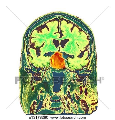 Stock Image - Pituitary tumour, CT scan. Fotosearch