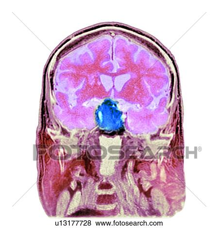 Pituitary tumour, CT scan View Large Photo Image Stock Photo - Pituitary tumour, CT scan. Fotosearch