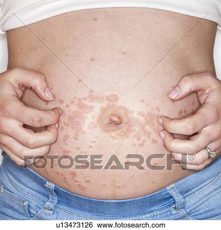 Pregnant woman scratching rash on tummy View Large Photo Image Stock Photograph - Pregnant woman scratching rash on tummy. Fotosearch